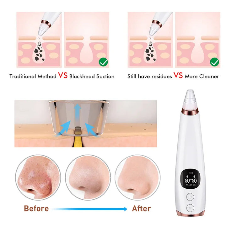 Electric Blackhead Remover Vacuum Acne